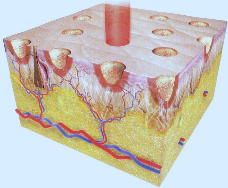 laser termolisi zatikatua