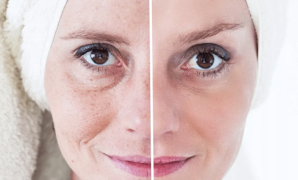 laser aurpegiko gaztetzea